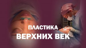 Пластика верхних век до и через один месяц после операции