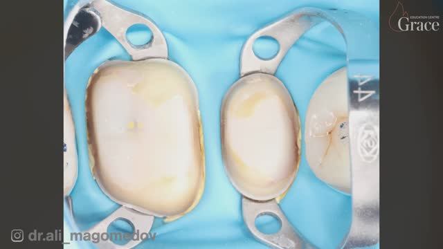 Коффердам. Урок от Али Магомедова смотреть онлайн