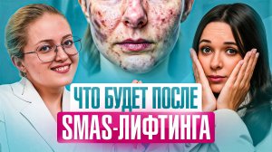 Что будет с вашим ЛИЦОМ после SMAS лифтинга через 365 дней?