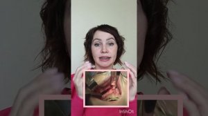 #24 Месяц после снятия сплинта. 3 месяца после ЧЛХ.