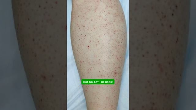 Запись на электроэпиляцию через wa 79688033388 #электроэпиляциямосква #электроэпиляция