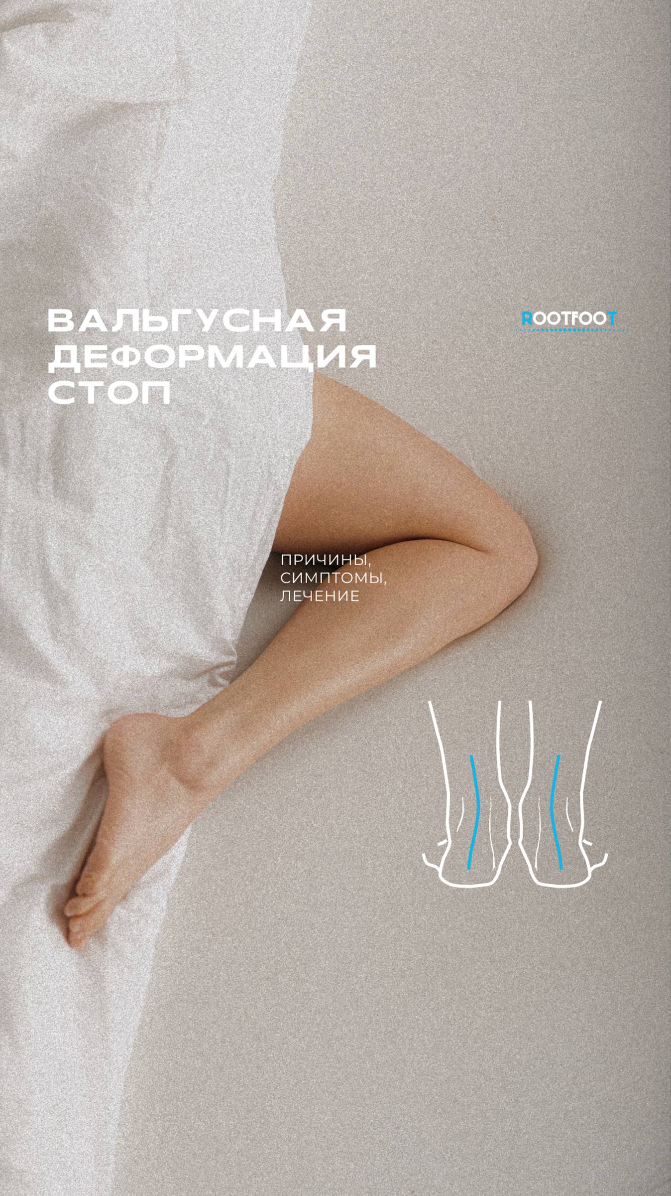Вальгусная деформация стоп: что это?