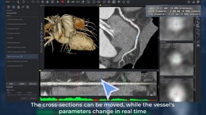 Дополнительный модуль анализа коронарных артерий в Inobitec DICOM Viewer Pro