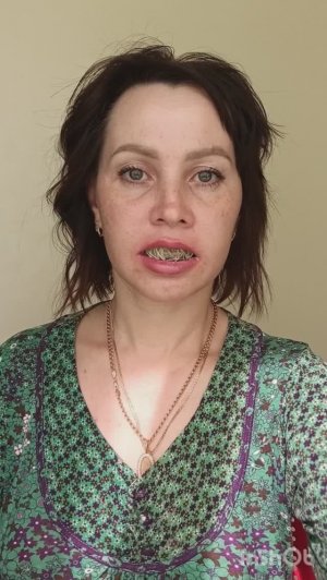 #20 Две недели после двухчелюстной остеотомии. Переломный момент в восстановлении.