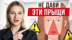 Почему ОПАСНО давить прыщи и как их правильно лечить?/НИКОГДА не делайте ЭТО со своим лицом!