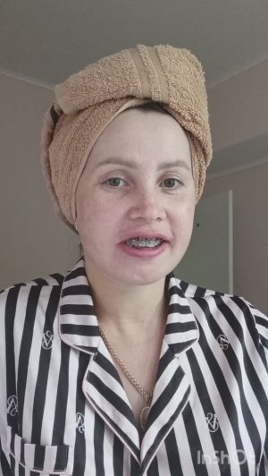 #19 десятый день после двухчелюстной сегментарной остеотомии.