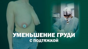 Уменьшение груди с подтяжкой: результат через 1 и 3 месяца после редукционной якорной мастопексии