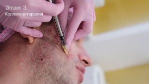 Рубцы постакне: план лечения (лазерная шлифовка, коллагенотерапия, биореструктуризация)