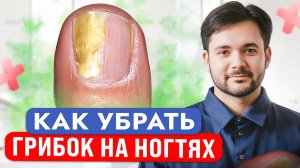 Этот СПОСОБ 100% Убьет Всех Паразитов на Ваших Ногтях! Как Вылечить Грибок Дома?