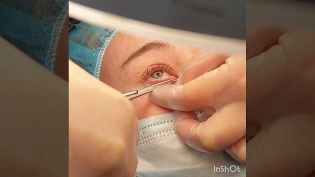 Удаление новообразования на веке