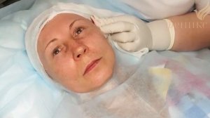 Процедура армирования лица нитями Аптос