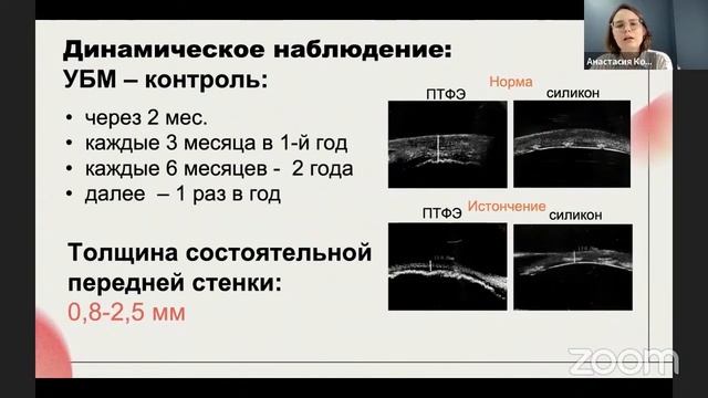 Котельникова А.В., Яровой А.А., Яровая В.А. Эндопротезирование орбиты: особенности ухода и наблюдени