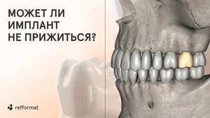 🔎 Тест на отторжение имплантов: может ли имплант не прижиться? И что дает гарантия на импланты?