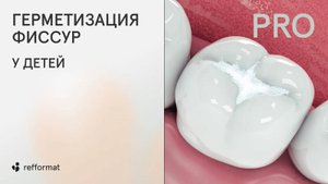 🦷 Герметизация фиссур у детей