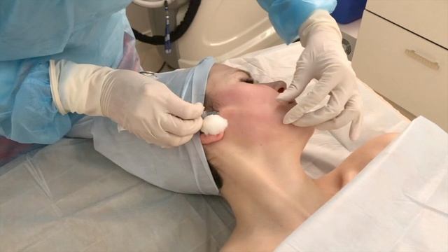 Безоперационный лифтинг лица нитями APTOS