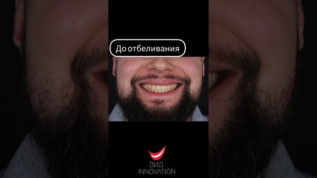 Отбеливание до и после. Результат на видео.