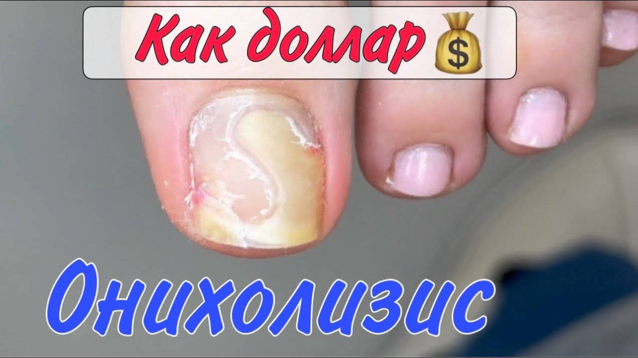 Оторвался ноготь_онихолизис_как зачистить ноготь