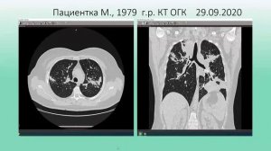 Изменения в легких при системных иммуновоспалительных ревматических заболеваниях