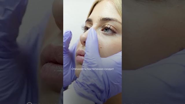 Кто-нибудь делал ринопластику? Поделитесь своим опытом 🙏🏻
