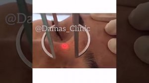 Лазерная шлифовка шрамов и рубцов на лице