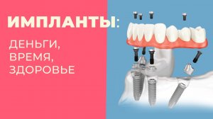 40. Dentures/Съемные зубные протезы: Продолжение серии ответов на ваши вопросы. Импланты?