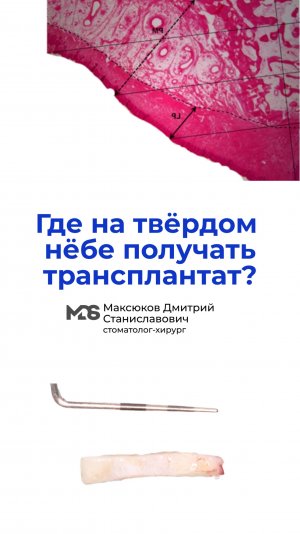 Где на твердом нёбе получать трансплантат ? Ближе к маргинальному краю или посередине?