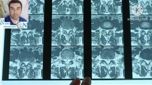 фораминальная грыжа, фораминальный стеноз, лечение без операции