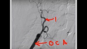 БЛЯШКИ МОГУТ НА 100% ЗАКРЫТЬ СОСУД, НО ЛЕТАЛЬНОГО ИСХОДА МОЖЕТ ЕЩЁ ДОЛГО НЕ СЛУЧИТСЯ?
