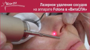 Лазерное удаление сосудов на аппарате Fotona