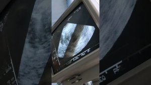 УЗИ 10 недель