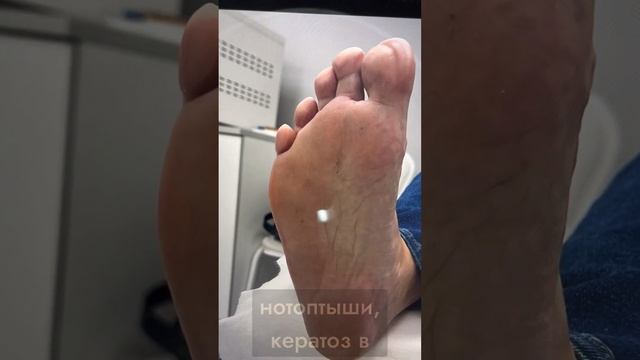 Обработка ногтей с грибковым поражением / НОГИМЕД смотреть онлайн