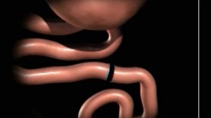 Лапароскопическое шунтирование желудка, gastric bypass