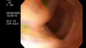 О паразитах в кишечнике