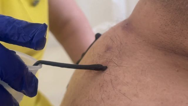 Гирудотерапия при пневмонии смотреть онлайн