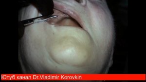 Состояние после имплантации 16 14 22  Снятие швов.