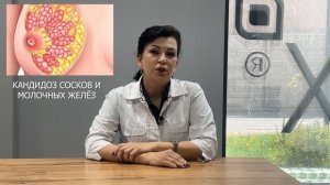 Молочница или кандидоз молочных желез