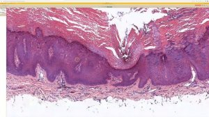 Epidermodysplasia Verruciformis (EDV): 5-Minute Pathology Pearls