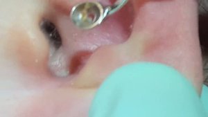Ear Blackhead extractions.Deep in the ear blackheads.Quick extractions, one dry, one juicy. MrPopZi