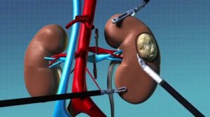 Лечение рака почки  Нефрэктомия