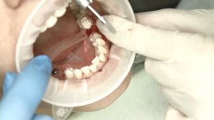 Одномоментная установка имплантата Dentium