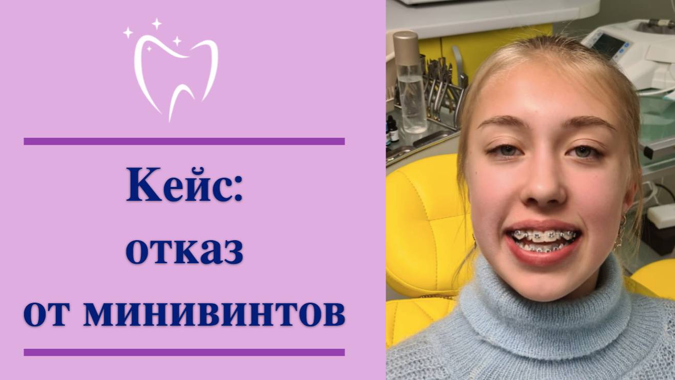 💎 Кейс: отказ от минивинтов