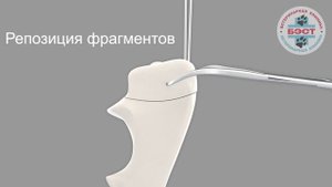 Наложение 8 ми образного проволочного шва
