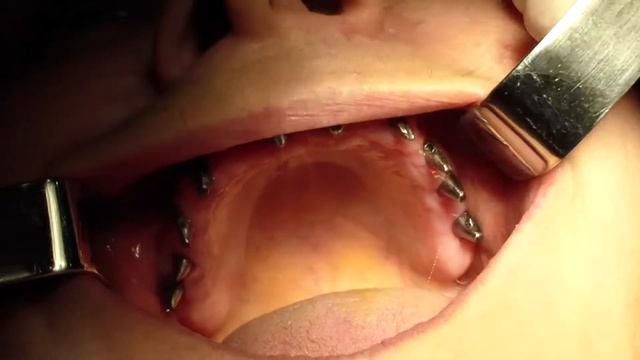 имплантация смотреть онлайн