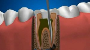 Лечение периодонтита