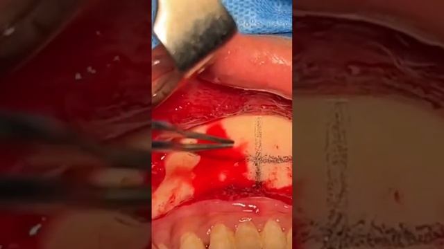 Chin Recontoruing Surgery