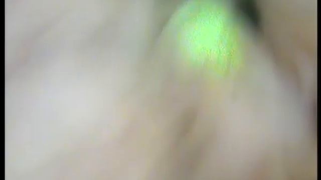 HoLEP first смотреть онлайн