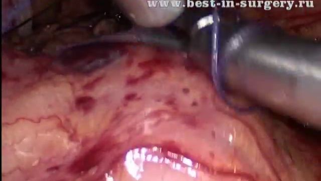 Симультанная лапароскопическая экстирпация и гемиколэктомия справа NOSE смотреть онлайн