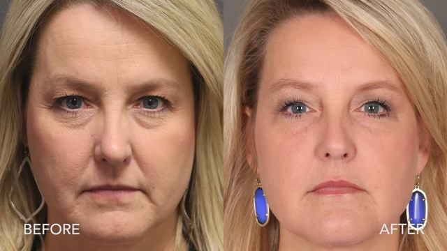 Hyaluronic Acid Dermal Filler смотреть онлайн