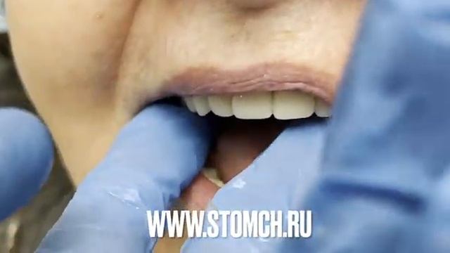 Протезирование полными съемными протезами в Липецке. Врач стоматолог Черных Максим Игоревич.