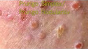 Prurigo Simplex/Prurigo Nodularis